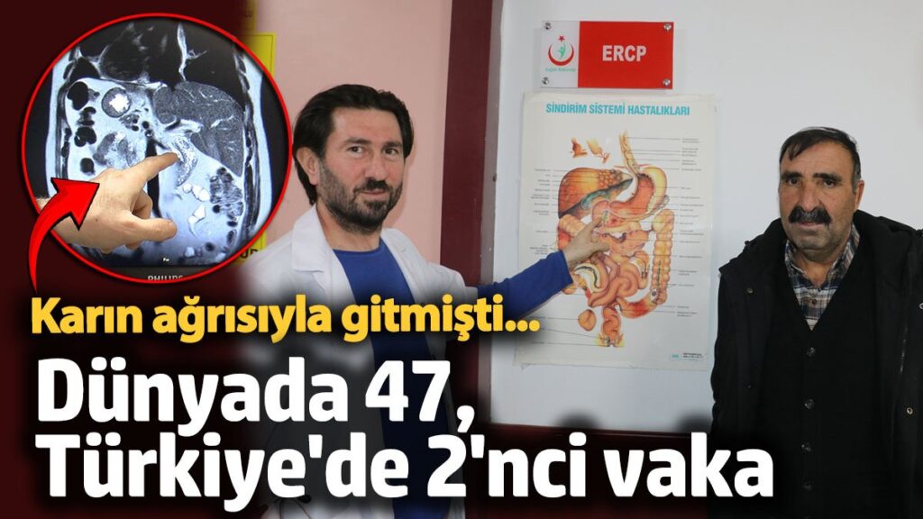 karin agrisiyla gitmisti dunyada 47 turkiyede 2nci vaka 5RQ85twE