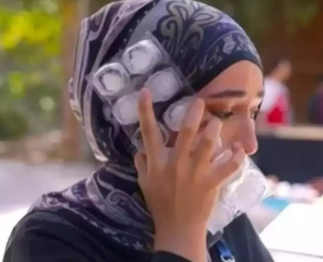 yuzune kizgin yag dokulmus kurgu denmisti masterchef beyza yuzunu ilk kez paylasti 3