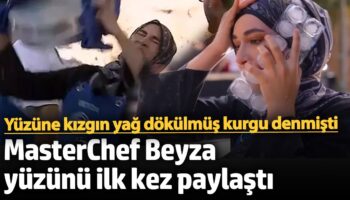 yuzune kizgin yag dokulmus kurgu denmisti masterchef beyza yuzunu ilk kez paylasti jhquy6EE