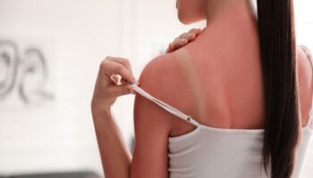 cildiniz alarm veriyor gunes yaniklarina dikkat cNMbq5CV