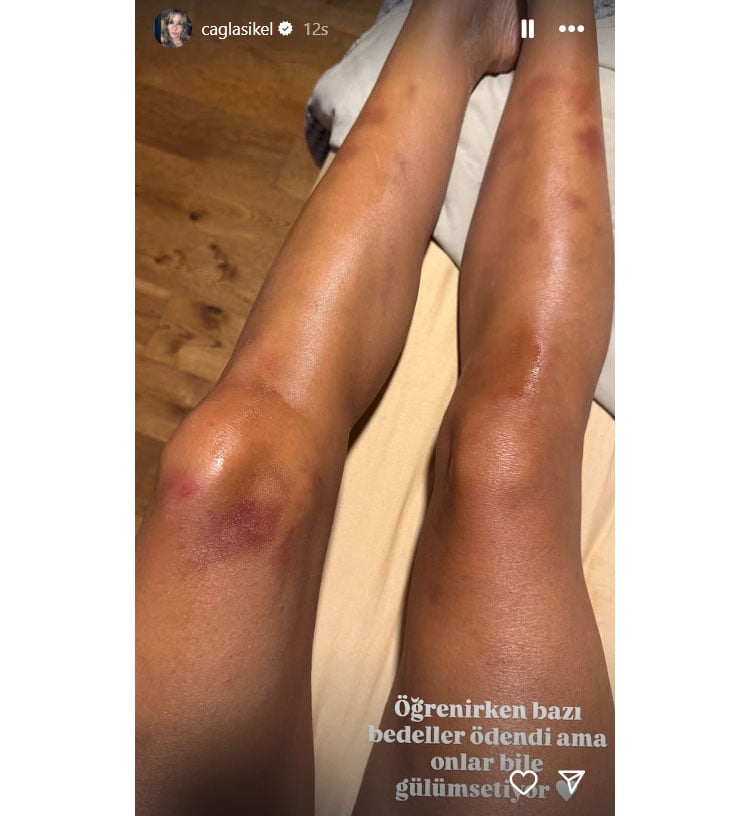 cagla sikelden dikkat ceken paylasim bacaklarindaki morluklar akillarda soru isareti yaratti 3 pK6C3rFj