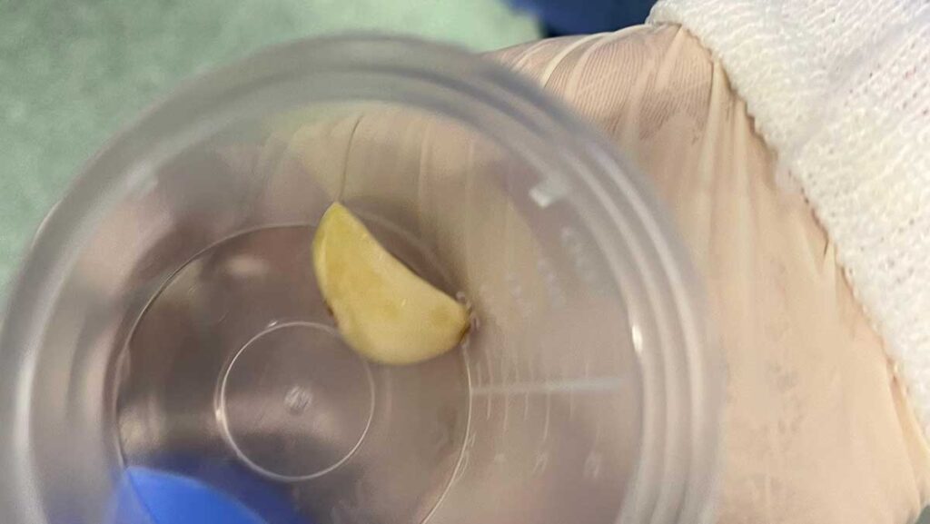 yasli adamin akcigerine kacan sarimsak operasyonla cikarildi kabXZzu8