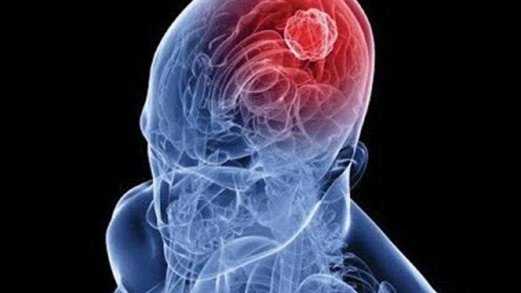 burun spreyiyle beyin tumorune dogrudan mudahale tip dunyasinda devrim QaAMQvRN