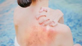 gunes yaniginin sonu geliyor uzmanlar anlatti UhPTJfiJ