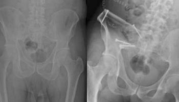 prostat kanserinin ileri evrelerindeki kemik tehlikesiyle uzman onerileri 2vGaxwKr