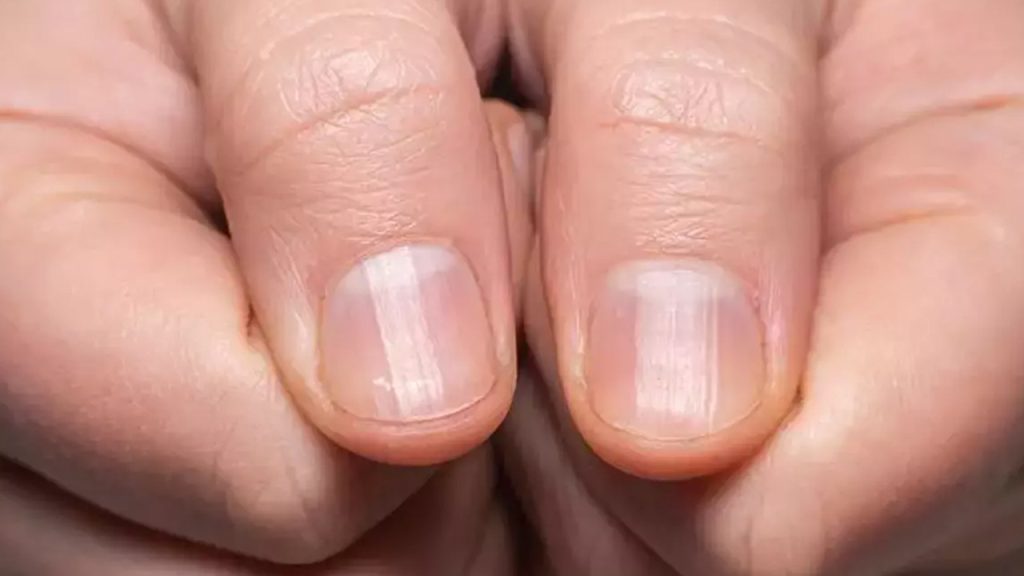 tirnaklardaki sessiz degisim akciger sagligini tehdit mi ediyor ZHx2GIDJ