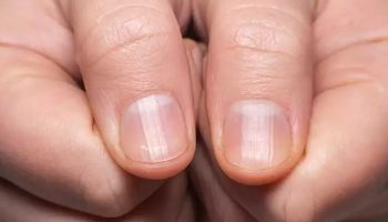 tirnaklardaki sessiz degisim akciger sagligini tehdit mi ediyor ZHx2GIDJ