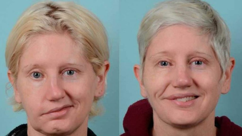 yuz felcinde altin saat uyarisi kalici hasar birakmamak icin kritik tuyolar 3uZUTPHs