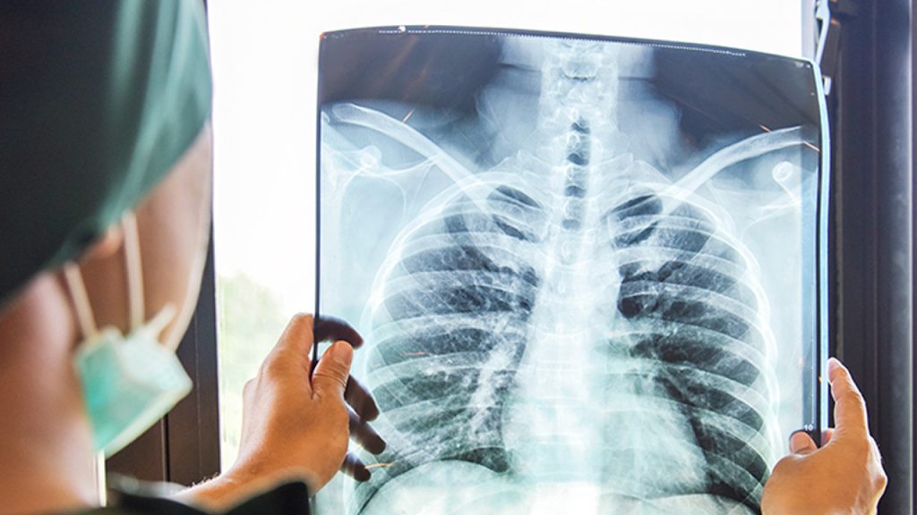 zaturre tedavisinde 4 saat kurali ortaya cikti TseM4liv