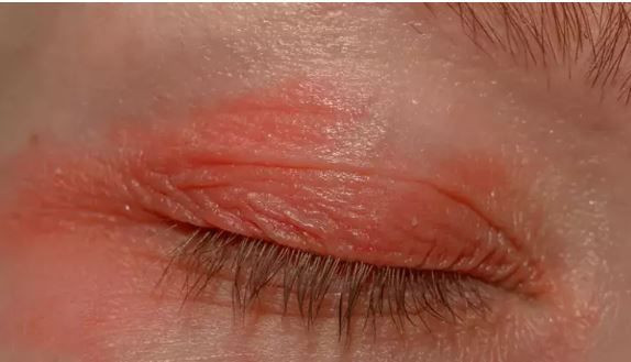 goz kasintisini hafife almayin nedeni bir parazit olabilir 1 PQRaunek