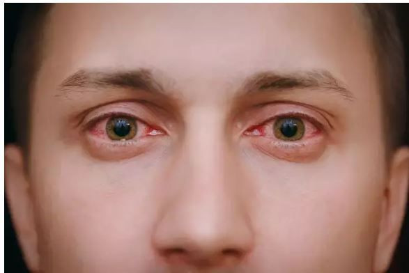 goz kasintisini hafife almayin nedeni bir parazit olabilir 2 qJmOHdUc